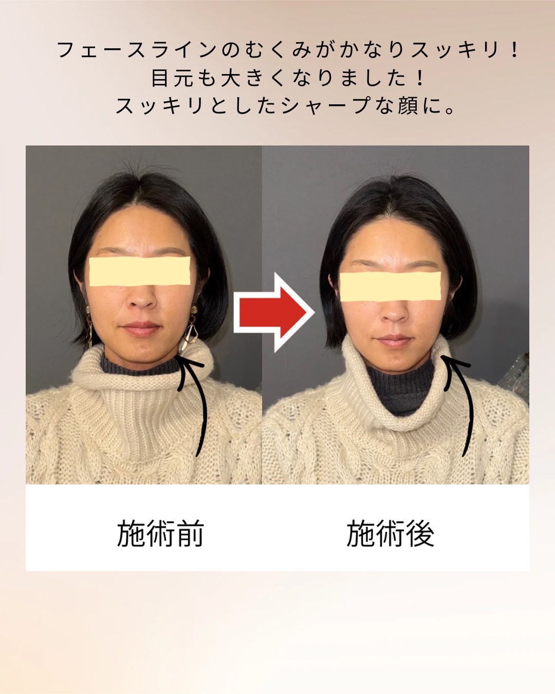 小顔整体 ビフォーアフター