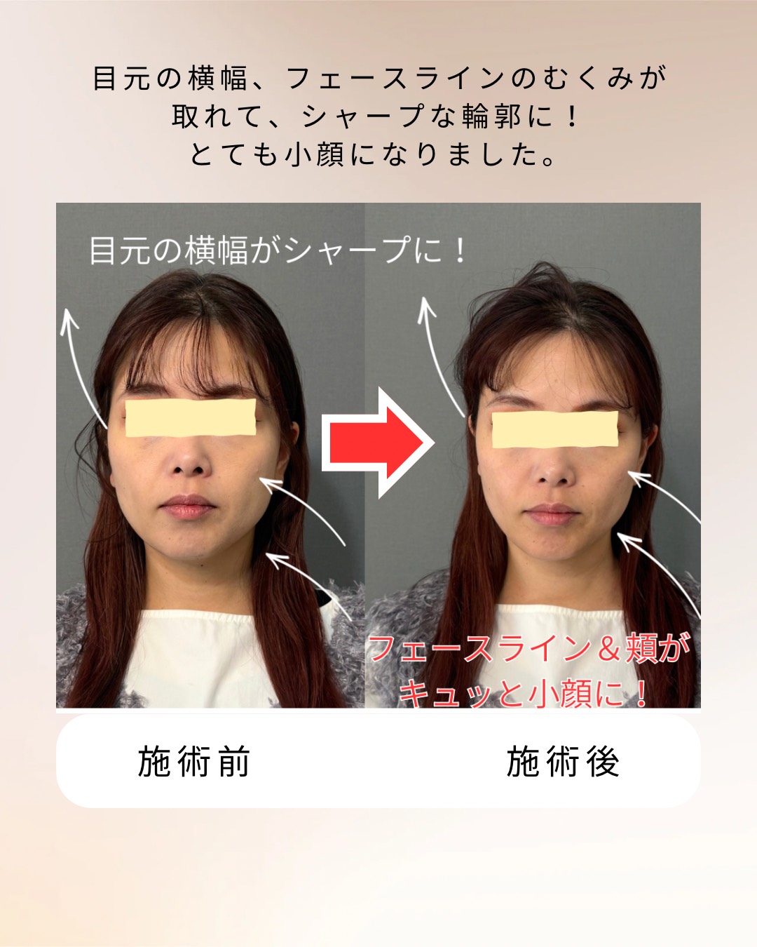 小顔整体の効果