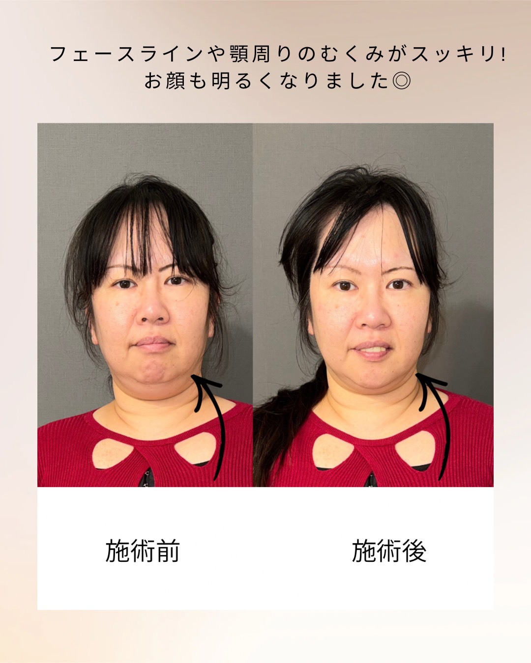 小顔整体 ビフォーアフター