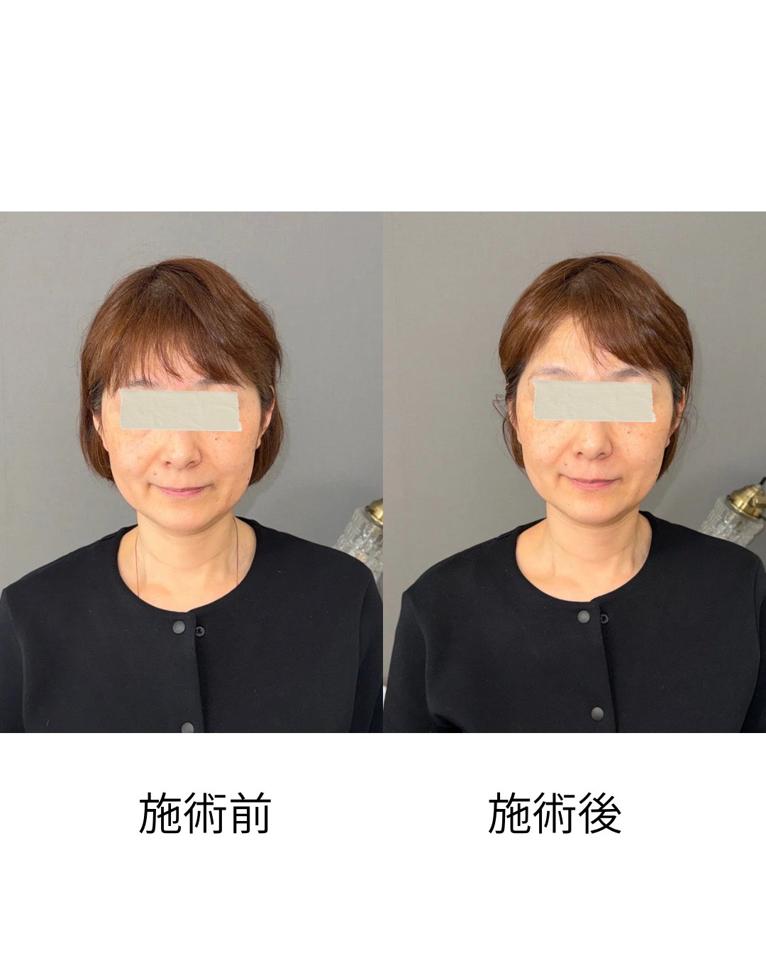 小顔整体 ビフォーアフター