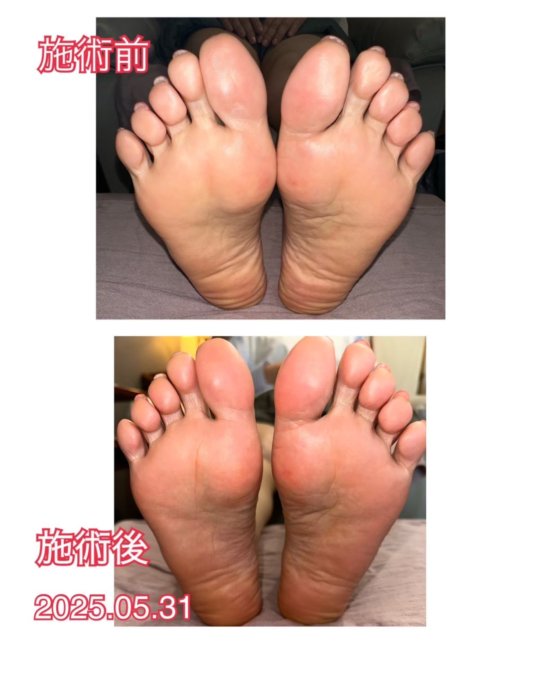 足裏のビフォーアフター比較（3枚目）