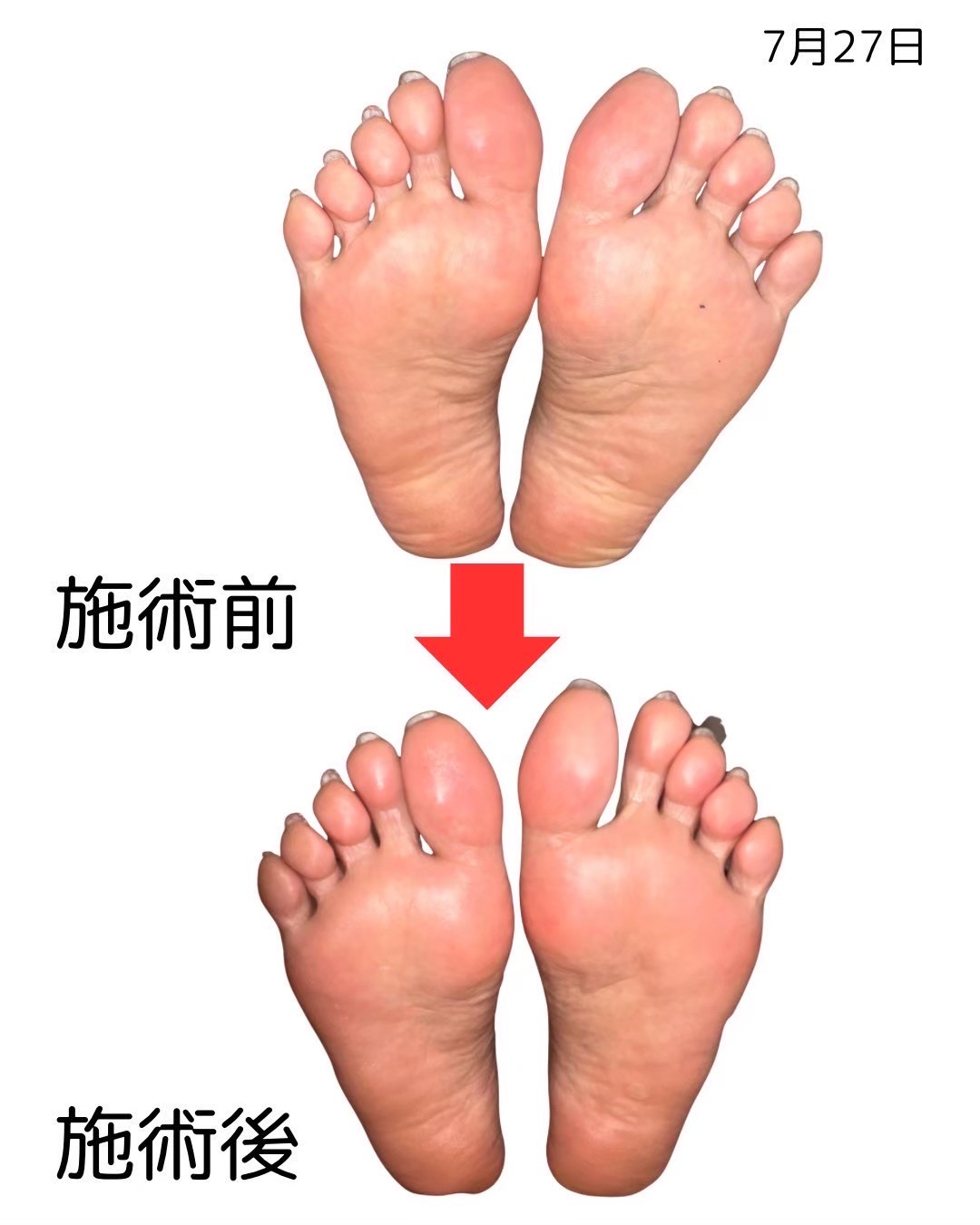 足裏のビフォーアフター比較（6枚目）