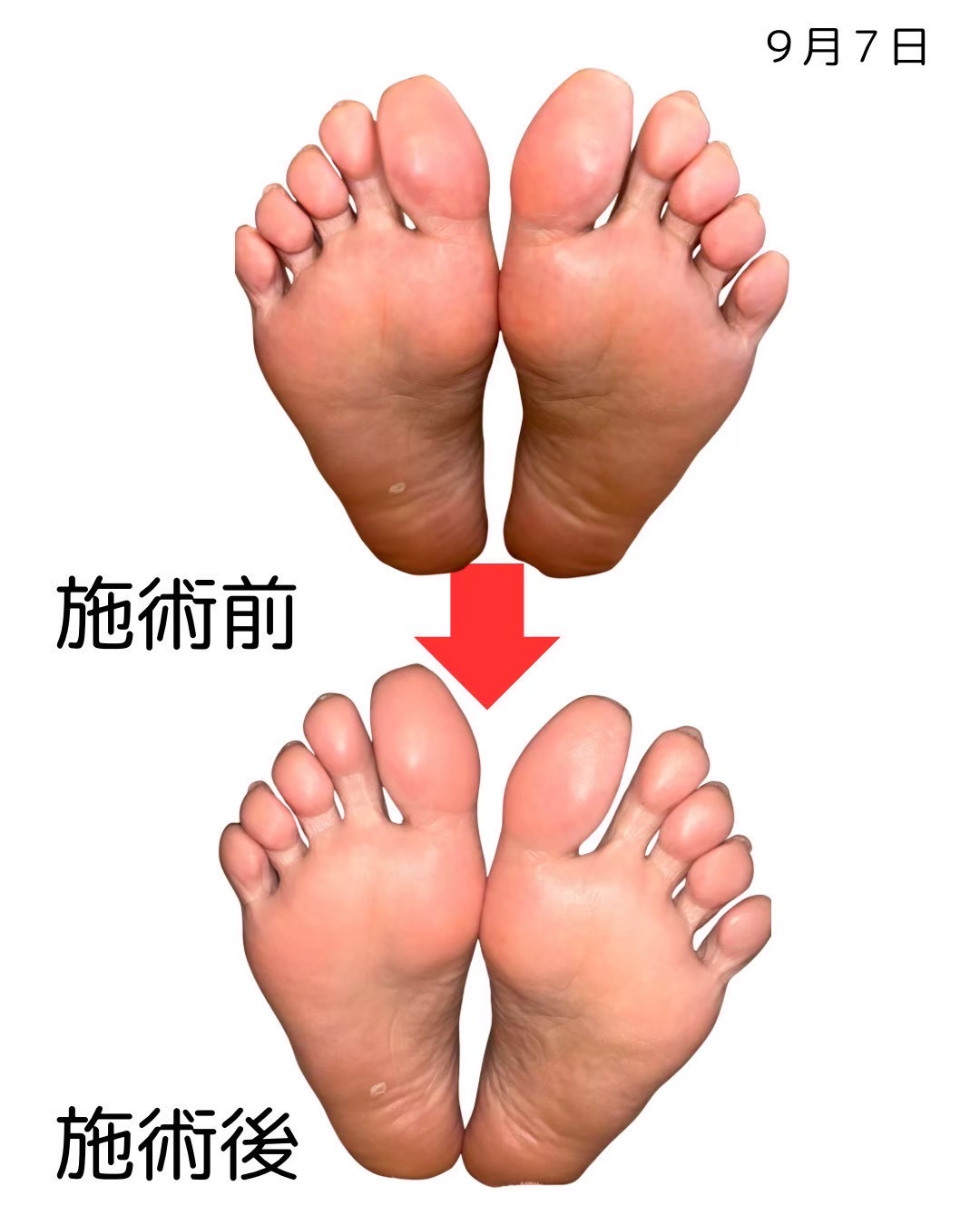 足裏のビフォーアフター比較（7枚目）