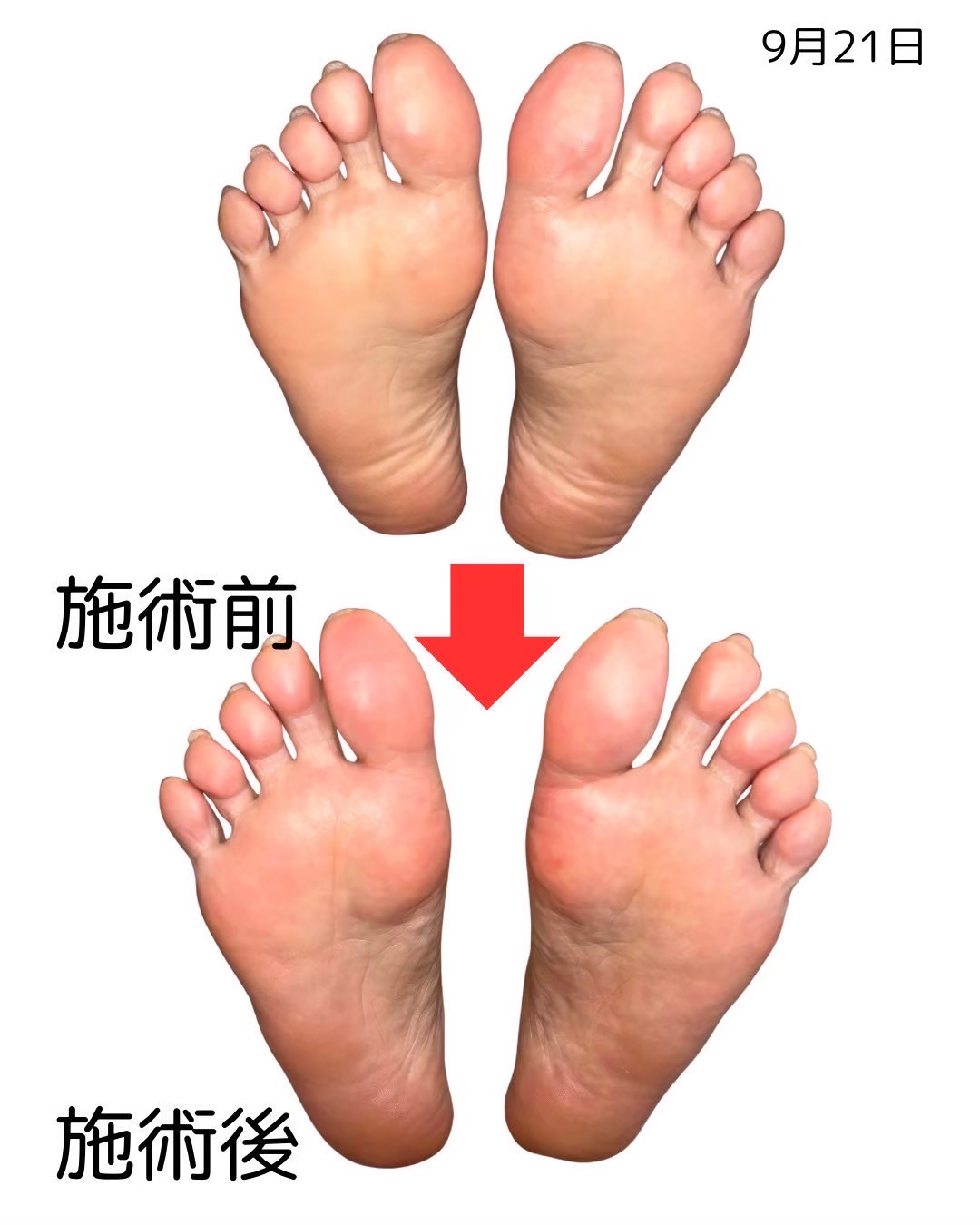 足裏のビフォーアフター比較（8枚目）