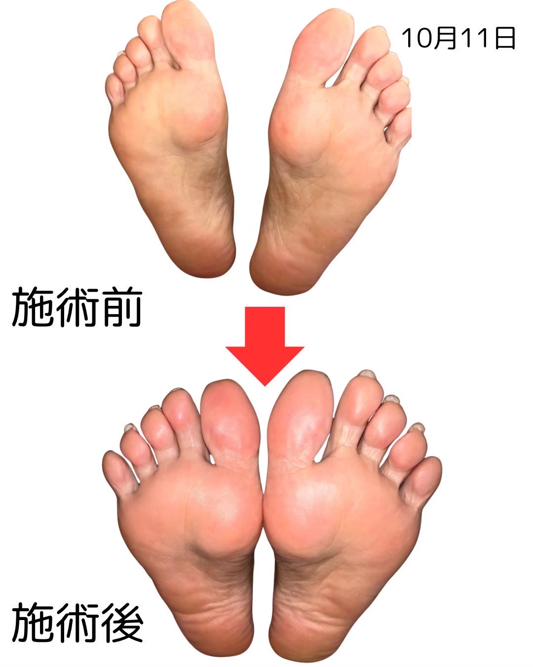 足裏のビフォーアフター比較（9枚目）