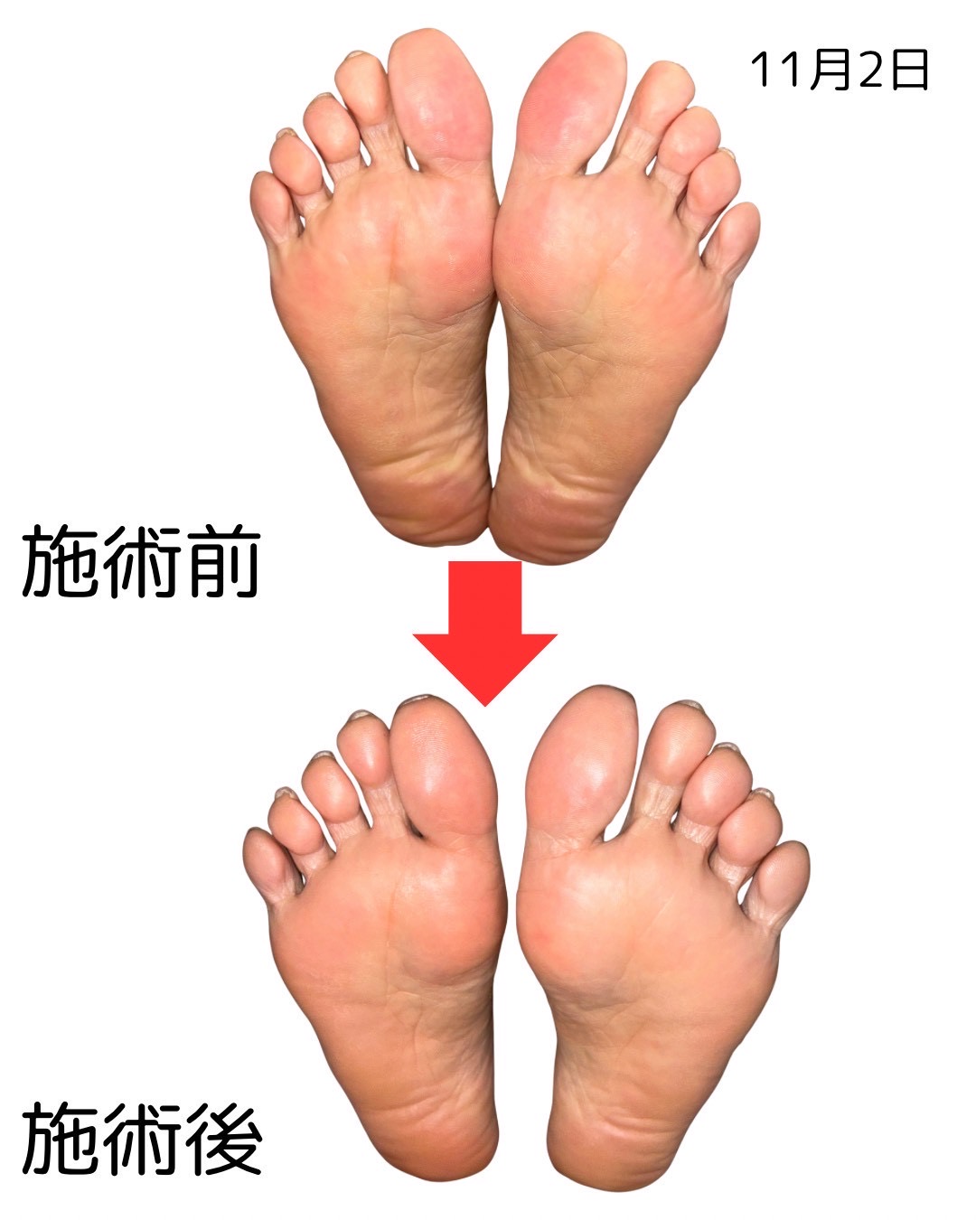 足裏のビフォーアフター比較（10枚目）