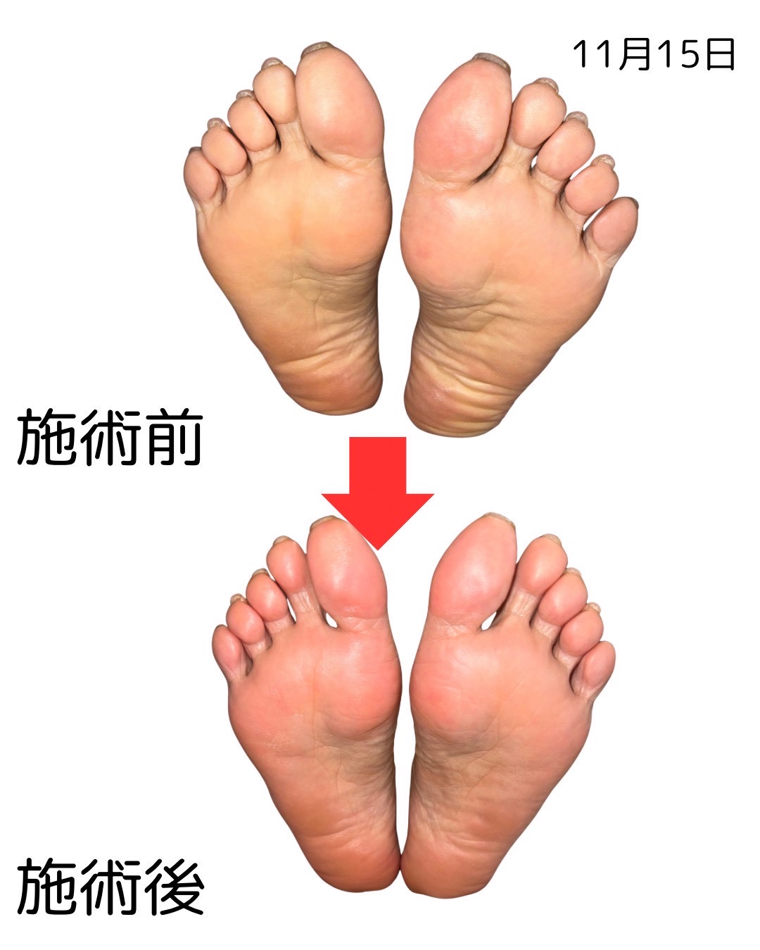 足裏のビフォーアフター比較（11枚目）