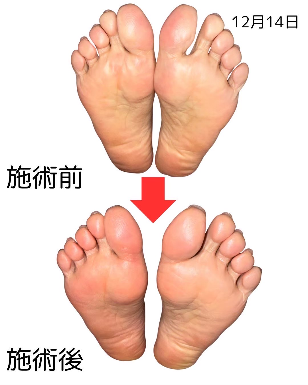足裏のビフォーアフター比較（12枚目）