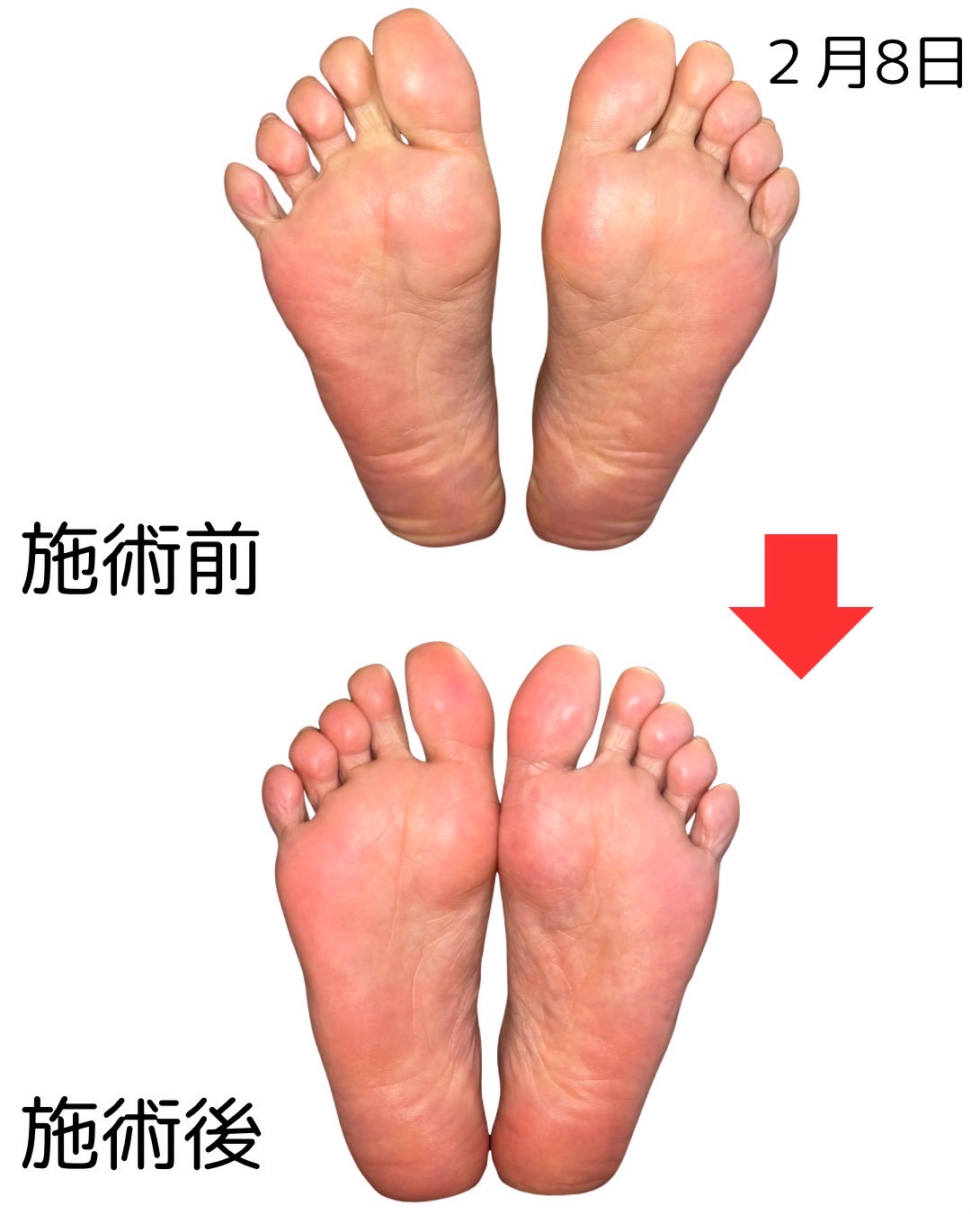 足裏のビフォーアフター比較（13枚目）